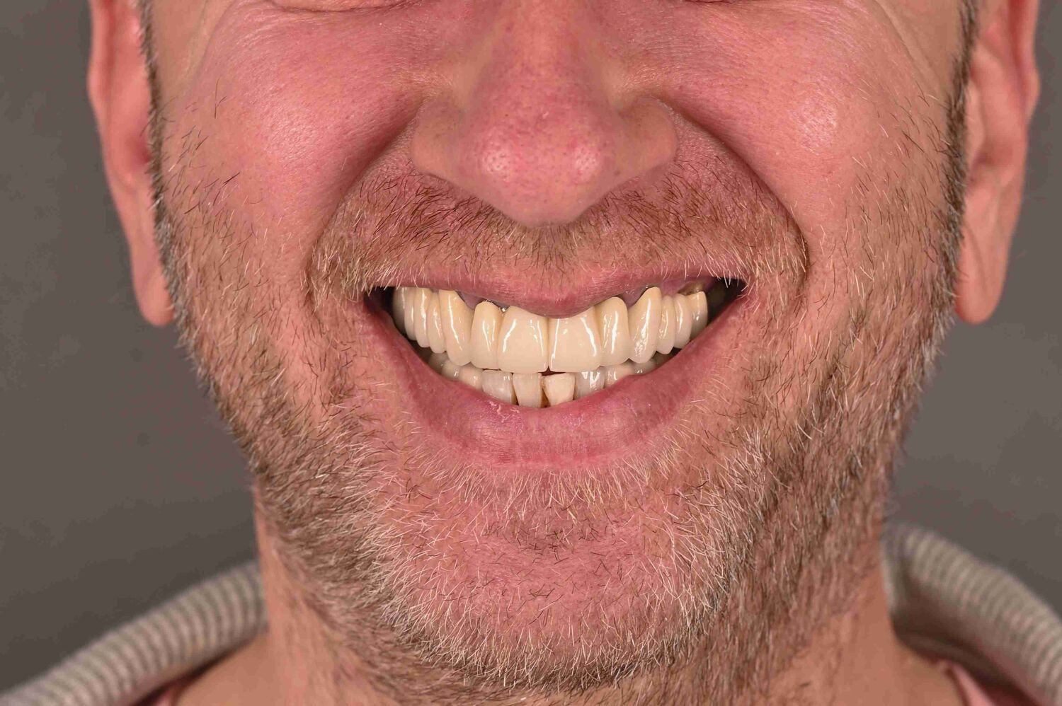 Pacient Clinica Dr. Alin Odor - Rezultat Implantologie